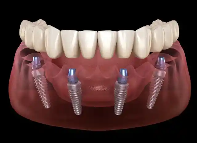 Dentures Were Made With Soldiers' Teeth